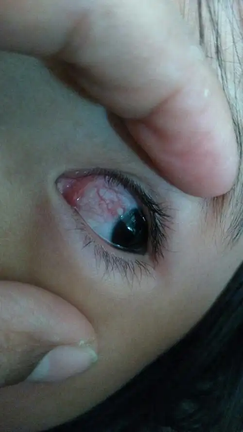 眼睛里面有白点