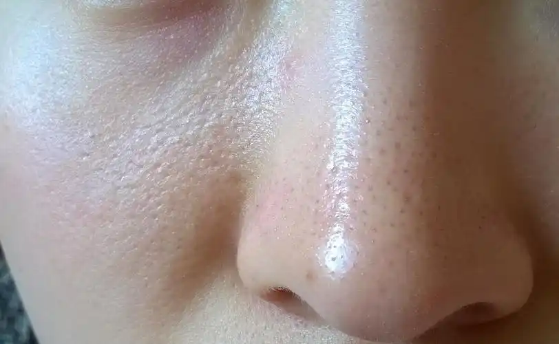 毛孔粗大不仅油性肌有敏感肌也有注意6点快速拯救粗大毛孔