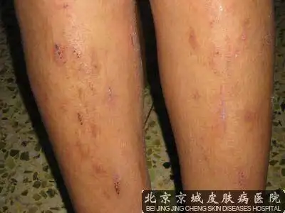 皮肤瘙痒是生活中常见的一种皮肤症状表现,由于原因不同病情也会不同