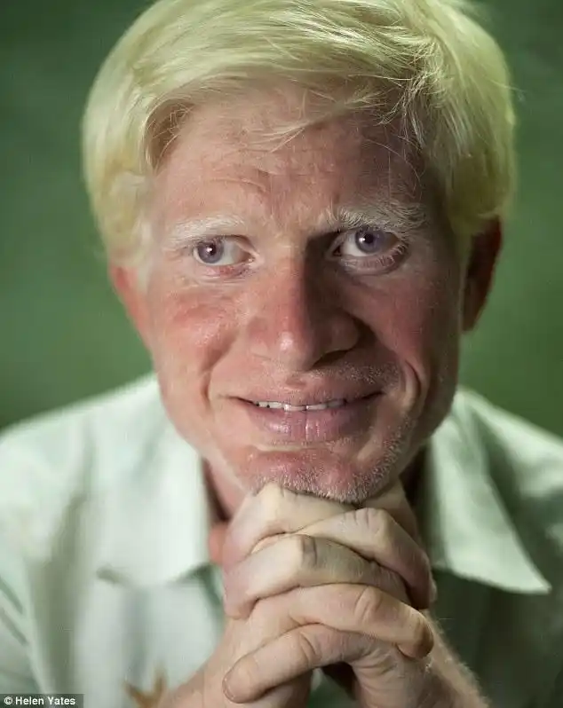 世界上最大的白化病家庭