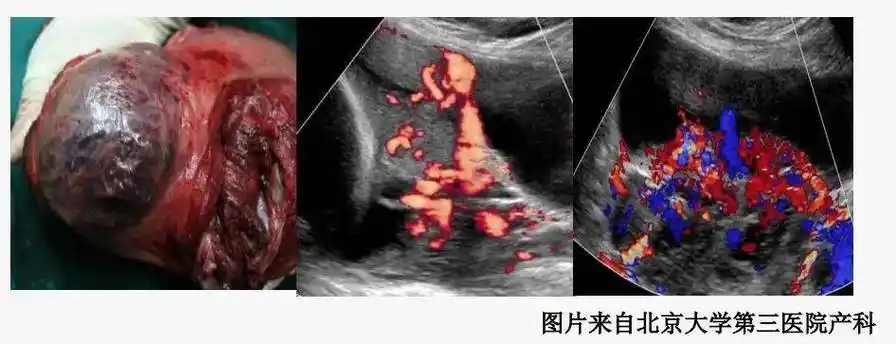 胎盘植入03【血管前置】血管前置亦称前置血管,指胎盘血管走行于胎膜