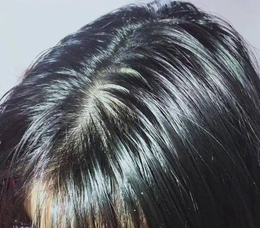 头发出油怎么治疗