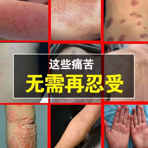 新品止痒膏皮肤瘙痒【药店同售】顽固皮肤症状反覆湿红痒过敏抑菌