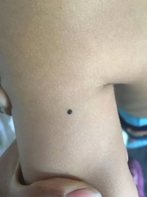帮我看看小孩这个痣是不是正常的