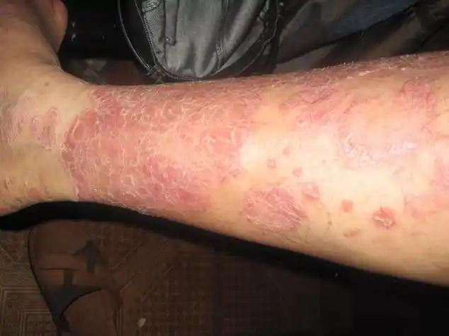 牛皮癣很痒怎么办?杜荣昌医生为您讲解