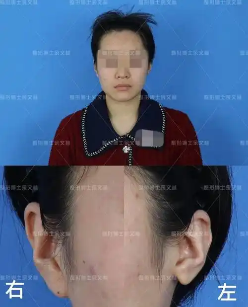 【案例分析】反骨耳 耳垂缺失的小姐姐,要求做手术增大耳廓