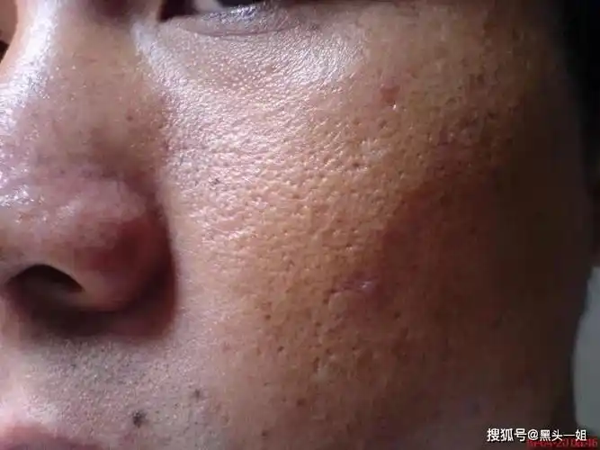 面部角质层厚,用什么护肤品去角质比较好?_皮肤