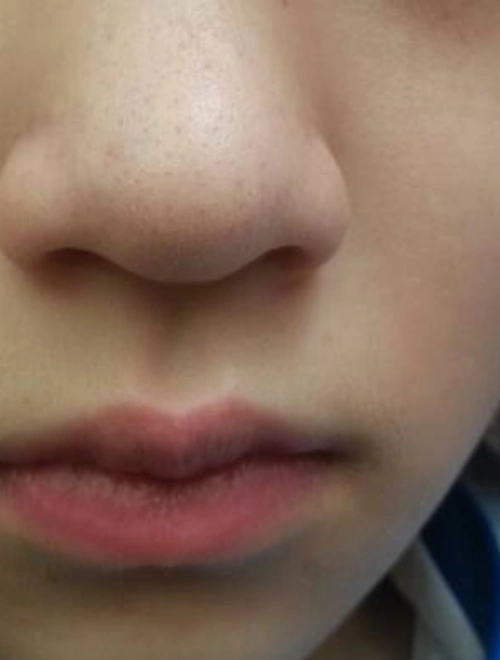 鼻子上的黑头图片放大