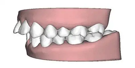 吃东西时总是咬到嘴巴你的牙齿咬合出问题啦