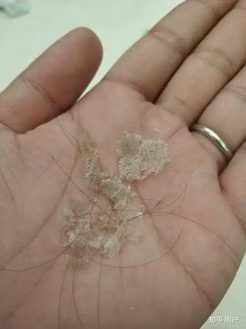 见过的最大头皮屑多大