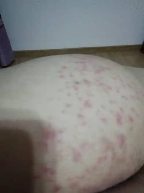 臀部每逢夏季就会长出很多痘痘,越热越痒,反复发作,用冰袋冷敷,或散热