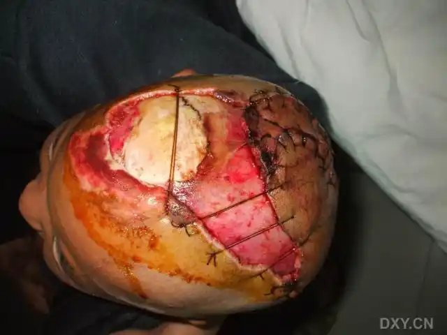 【讨论】一例头皮撕脱伤并皮肤软组织缺损治疗讨论 [病例帖]