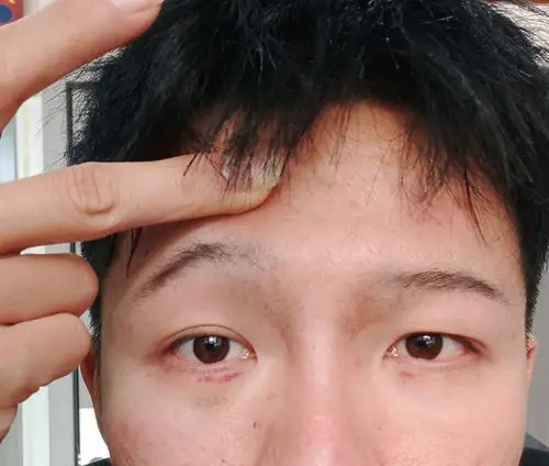 上眼睑提肌无力和脂肪厚能通过丰眉弓改善吗