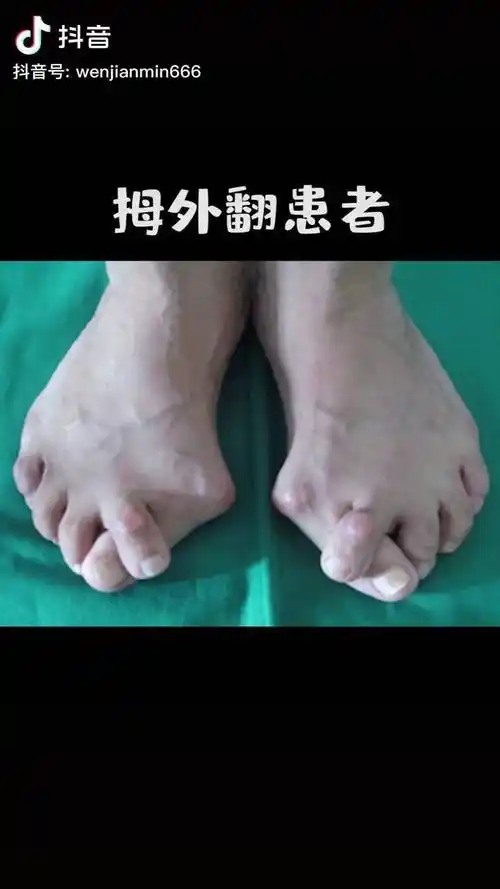 很多人对拇外翻不当回事不去zl拇外翻长期发展下去但是后果还是很严重