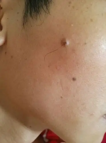 这种痣上长毛了,可以去掉吗?怎么去,有图