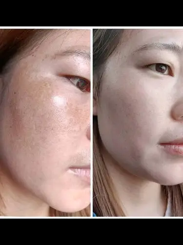 改善斑点前后对比脸干净就是自信
