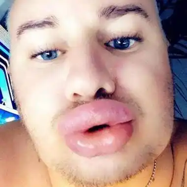 32岁男子花巨资整容20多次,结果整容成香肠嘴_roux