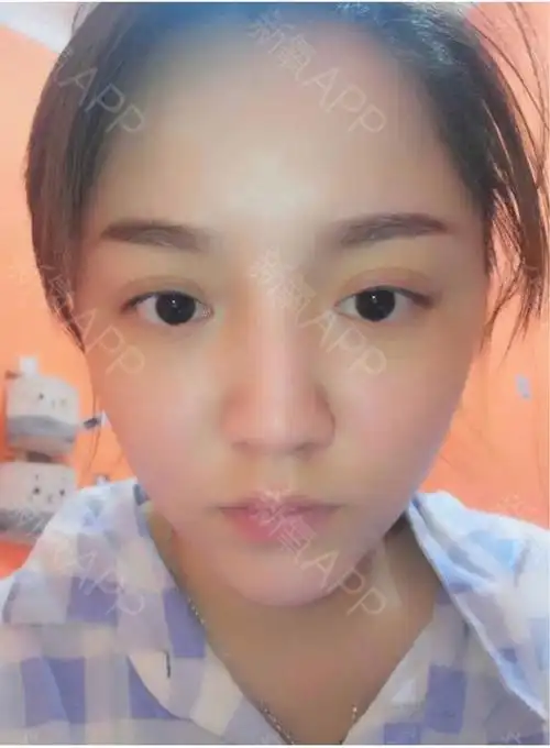 江澄南路18号恒大城玻尿酸丰泪沟好不好_效果图_氧气0b0i3玻尿酸丰