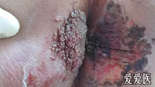 尖锐湿疣 - 皮肤及性传播疾病讨论版 - 爱爱医医学论坛 - 爱爱医医学
