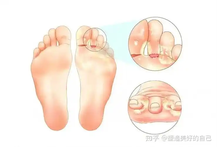 洁达宁:湿疹和手足癣病如何分别? - 知乎