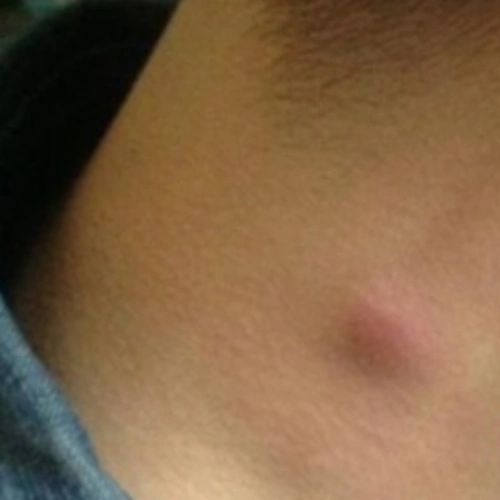 中年下肢淋巴癌早期症状图片