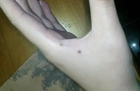 【女人右手虎口有痣权贵】右手虎口有痣的女生,与她们相处一段时间后