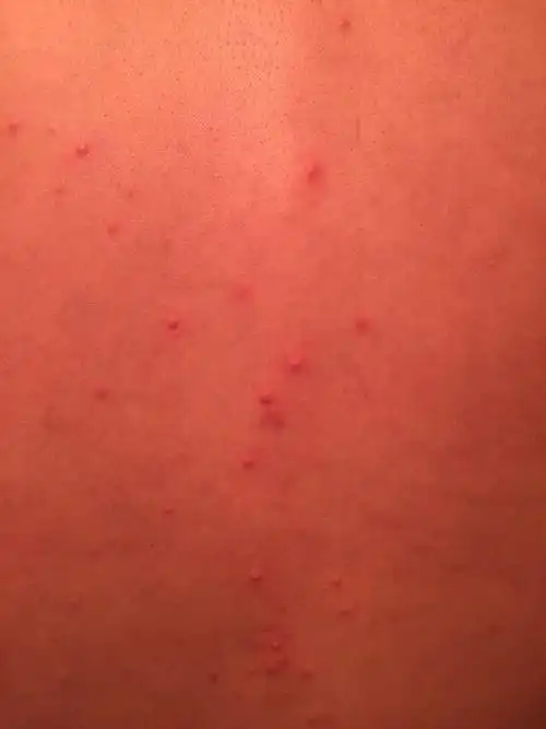后背突然起了很多红色的小疙瘩