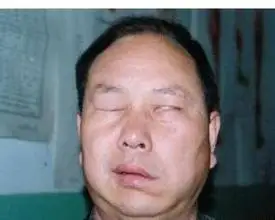 新疆一建医院为您制订最好的面神经炎治疗方案