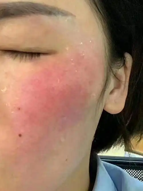 脸过敏去红血丝怎么办?敏感肌自救过程!