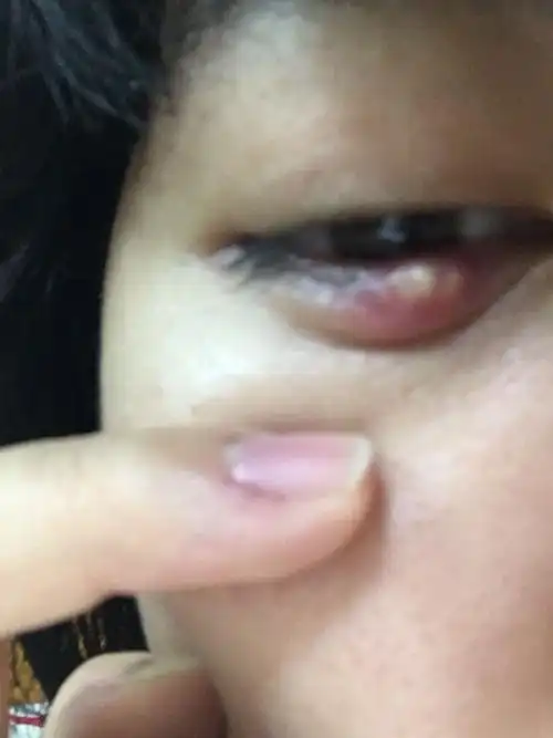 天气冷为什么眼睛红痛(天气转凉眼睛为什么会痛)