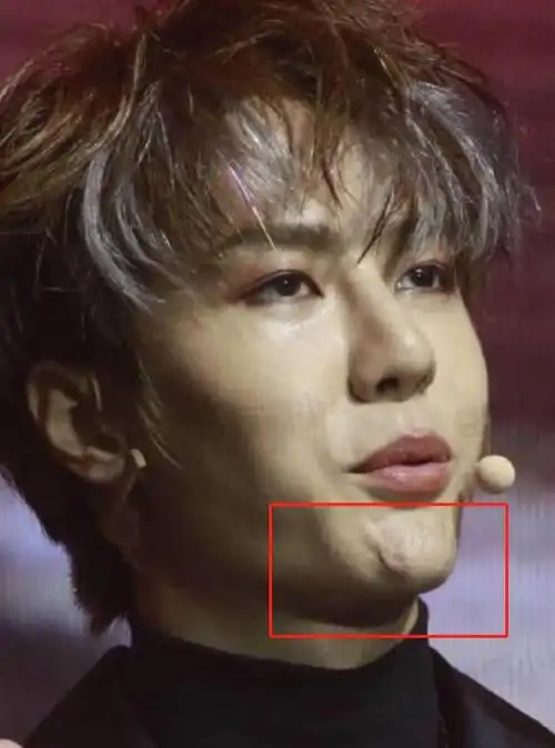 王一博被医生公开质疑整容粉丝直言不影响喜欢整容还算污点么