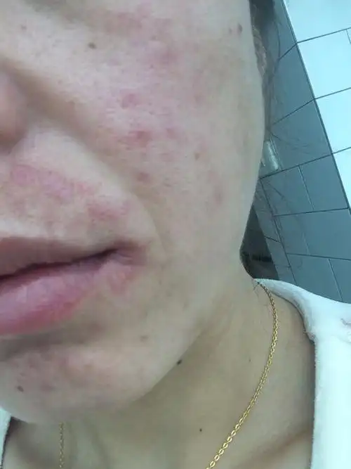 我脸上毛囊炎很严重,已经感染流黄水,一片片的,破了的地方还往出转毛