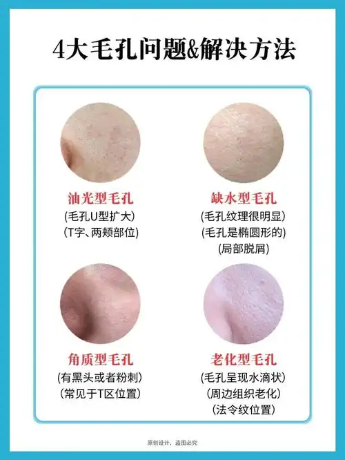 原因是因为皮肤油脂分泌过多导致的皮肤代谢太差也会长闭口,毛孔粗大