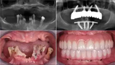 老人装全口假牙哪种好?种植牙,义齿这些方式都适合老年人哦!-医秀网