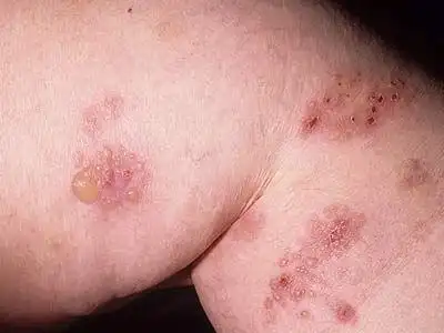 疱疹样皮炎综述