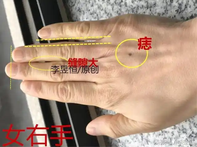 手相:黑痣出现在手背这3个位置,早晚必发,一生不为钱财犯愁!