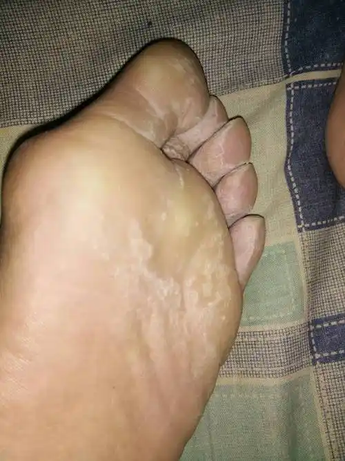 前脚掌痛一般属于跖痛症概述跖痛症是指前足横弓劳损或跖神经受压或