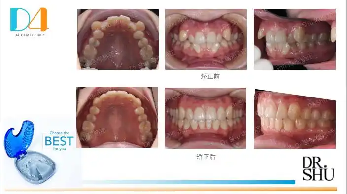 (隐形矫正虎牙不拔牙案例)我们上颌的牙齿包括前牙,侧切牙和尖牙.