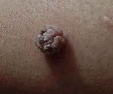 皮肤科的大神请进,手腕上长了一个肉瘤!