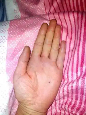 本女手相如何,求解说,最近手掌里还长一颗痣