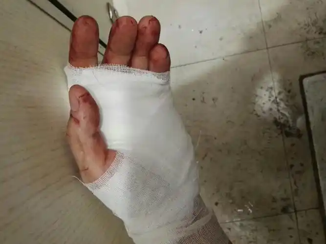 外科手割伤缝合后情况刚从医院回来,手食指和中指间刀刺伤,伤口1厘米