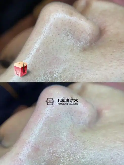 毛囊清洁术除了深层清洁之外,还有以下几大功效: 第一:市面上唯一一款