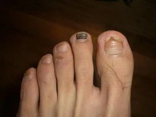 肝癌早期不疼不痒只要脚指甲出现1个信号癌症说来就来