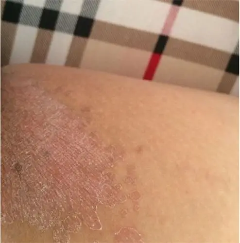 女性股藓症状表现的图片_有来医生