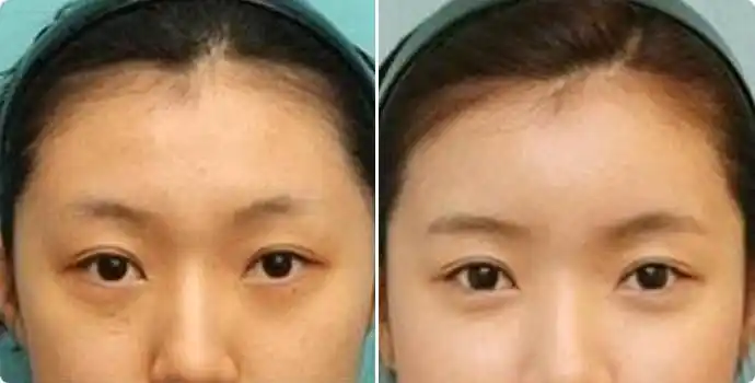 丰额头前后对比图 玻尿酸丰额头效果图 玻尿酸丰额头前后对比照片