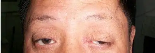 邓铁涛 《中国百年百名中医临床家丛书:邓铁涛卷》重症肌无力是一