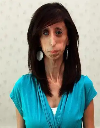 曾破吉尼斯最瘦纪录的骷髅女孩,只有27公斤,如今成励志女孩