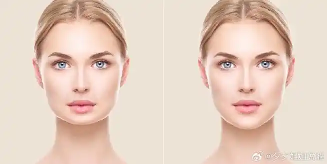 给大家看几张下巴短小,下巴后缩,双下巴前后对比图片,下巴对面部