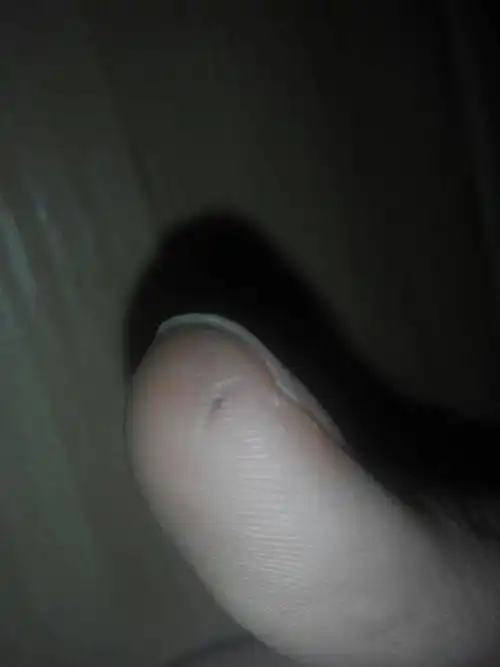 小伤口在结痂,里面却发现有一条黑色的东西,这是什么情况?污垢?