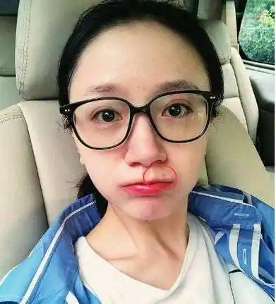 原创她凭一颗痣成名是黄轩的初恋女友点掉痣后变成这样